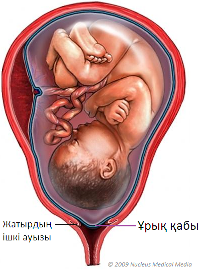 Ұрық қабының ерте жарылуы қаншалықты қауіпті? Ұрық қабы, Амниотикалық қапшық, Ұрық қабының ертерек жарылуы